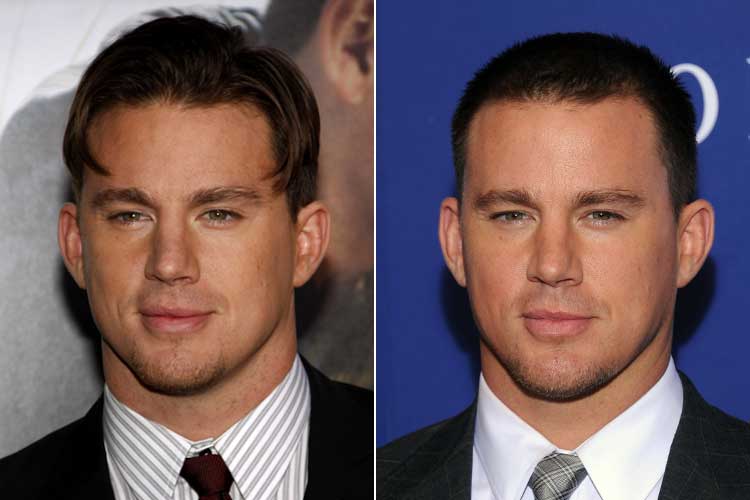 Channing Tatum juvenile vs mature hairline