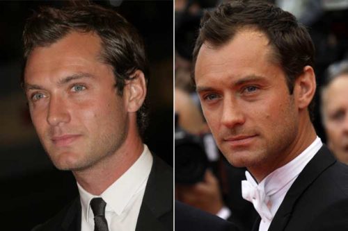 14 Male Celebrities with Receding Hairlines - Bald & Beards