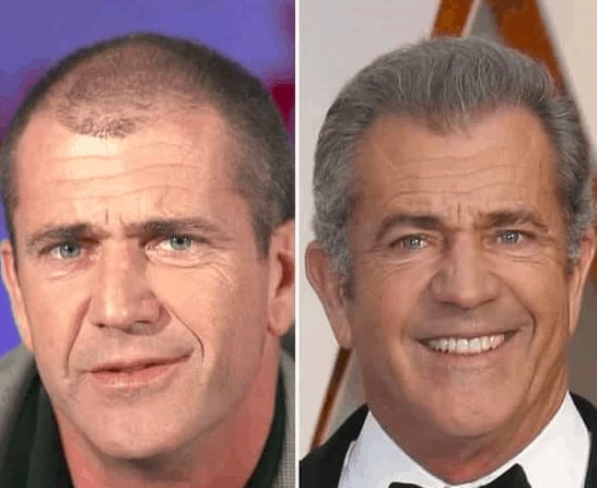 Mel Gibson celebrity hair transplant (before and after).