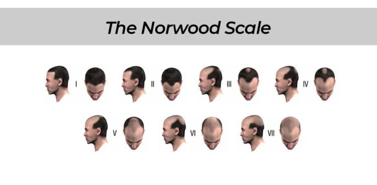 Norwood baldness scale