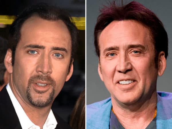 Celebrity Hair Transplants You Must See Bald Beards