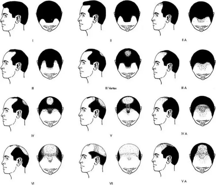 Determine your hairline maturity stage - Norwood scale hair loss diagram