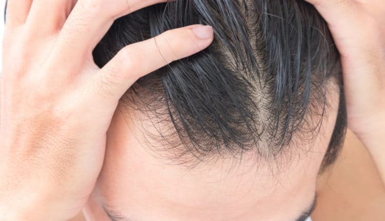 Prevent Receding Hairline