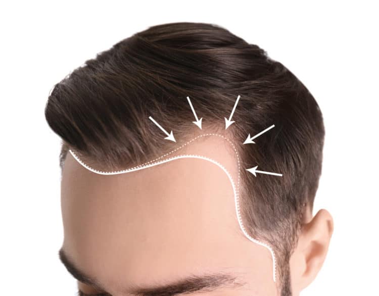 A bad hairline will affect the temple area & recede.