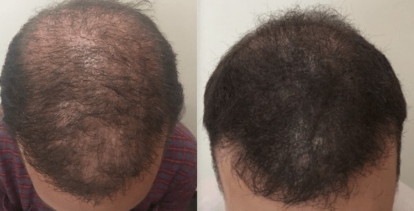 Adding scalp micropigmentation plus FUE creates a thicker look.