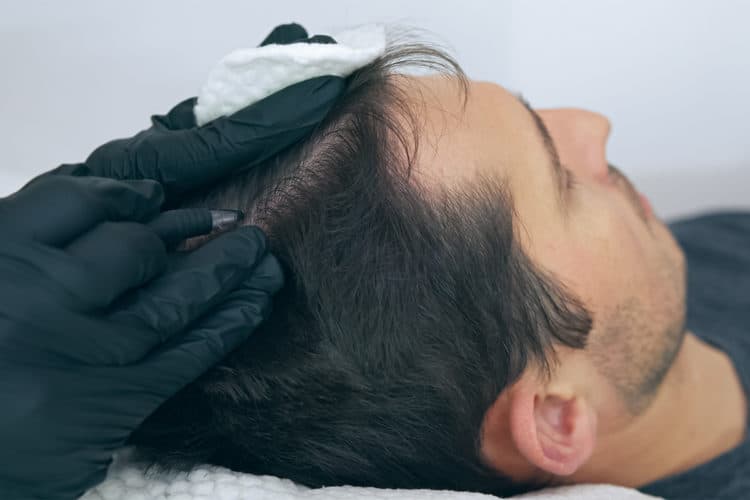 scalp micropigmentation costs