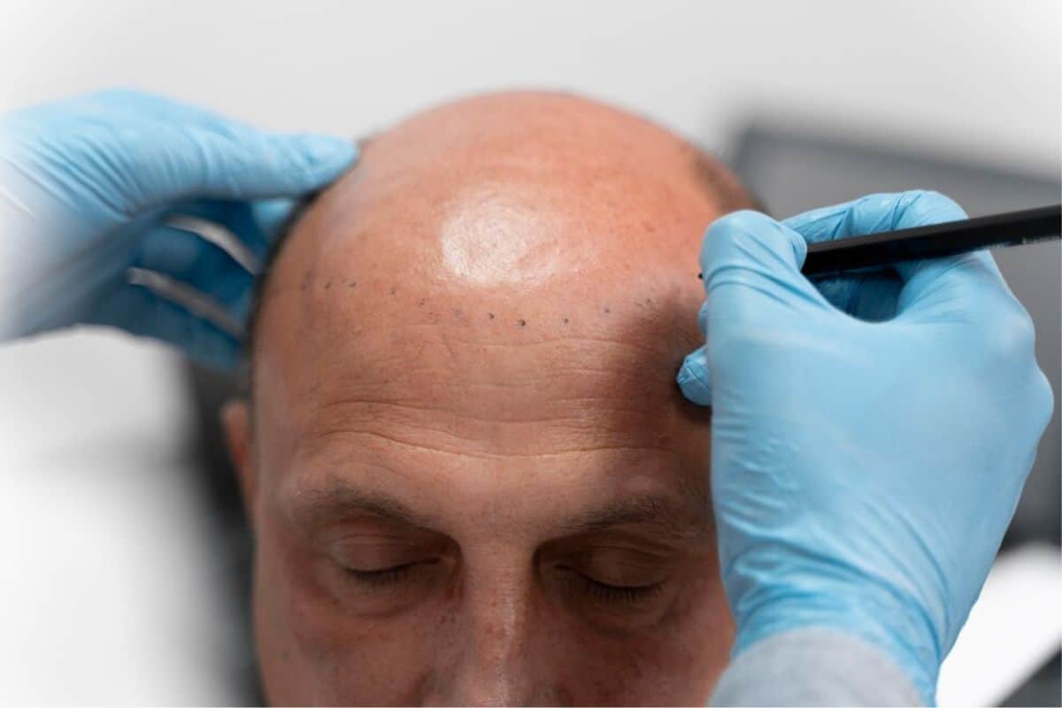 scalp micropigmentation grey hair