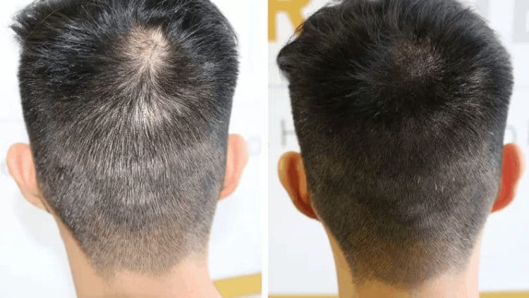 scalp micropigmentation after transplant