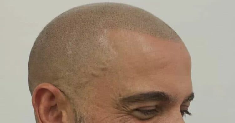 scalp micropigmentation with grey tones