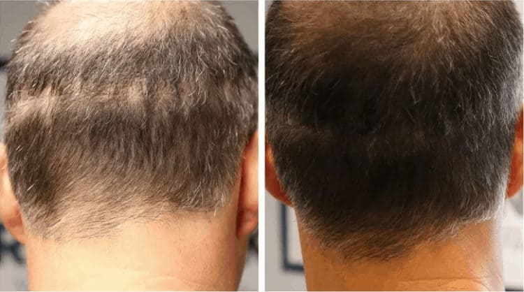 Scalp micropigmentation to hide FUT scar