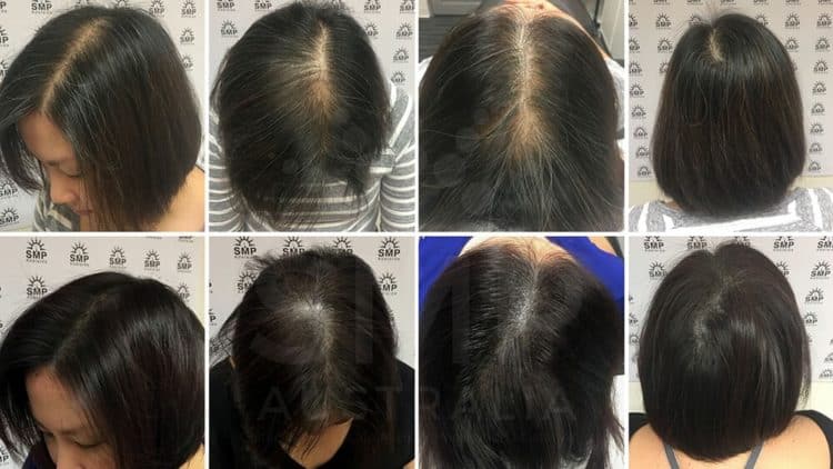 Scalp micropigmentation for women has amazing results.