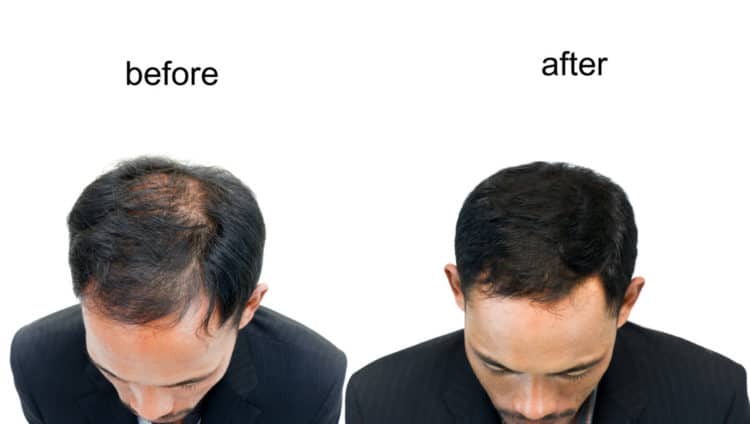 Before after SMP and FUE procedure