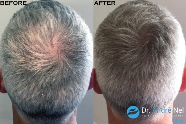 Scalp pigmentation for density after transplant