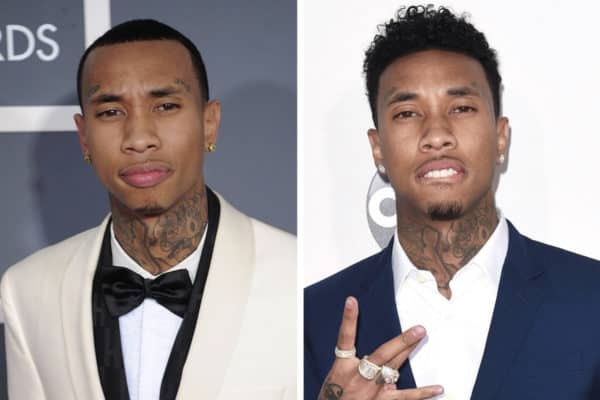 Tyga celebrity hair transplant (before and after).