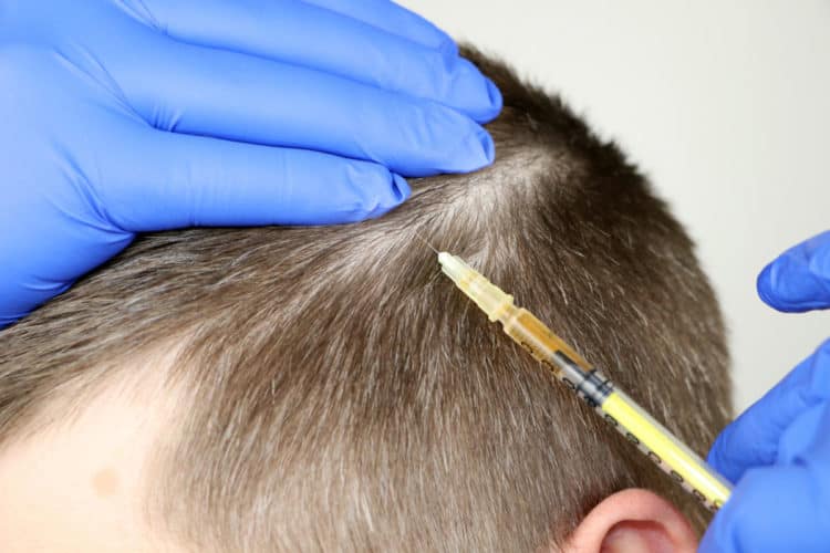 Platelet-rich plasma (PRP) after a hair transplant with faster density and reduces transplanted hair loss.