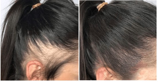Scalp micropigmentation for women - before and after results.